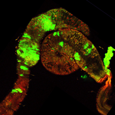 tumeurs dans le tube digestif d'une drosophile